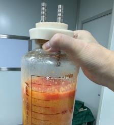 青州水动力吸脂手术要做多久？